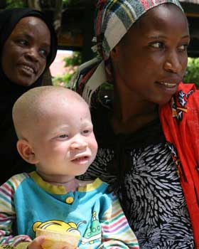 Albinismo en persona afrodescendiente